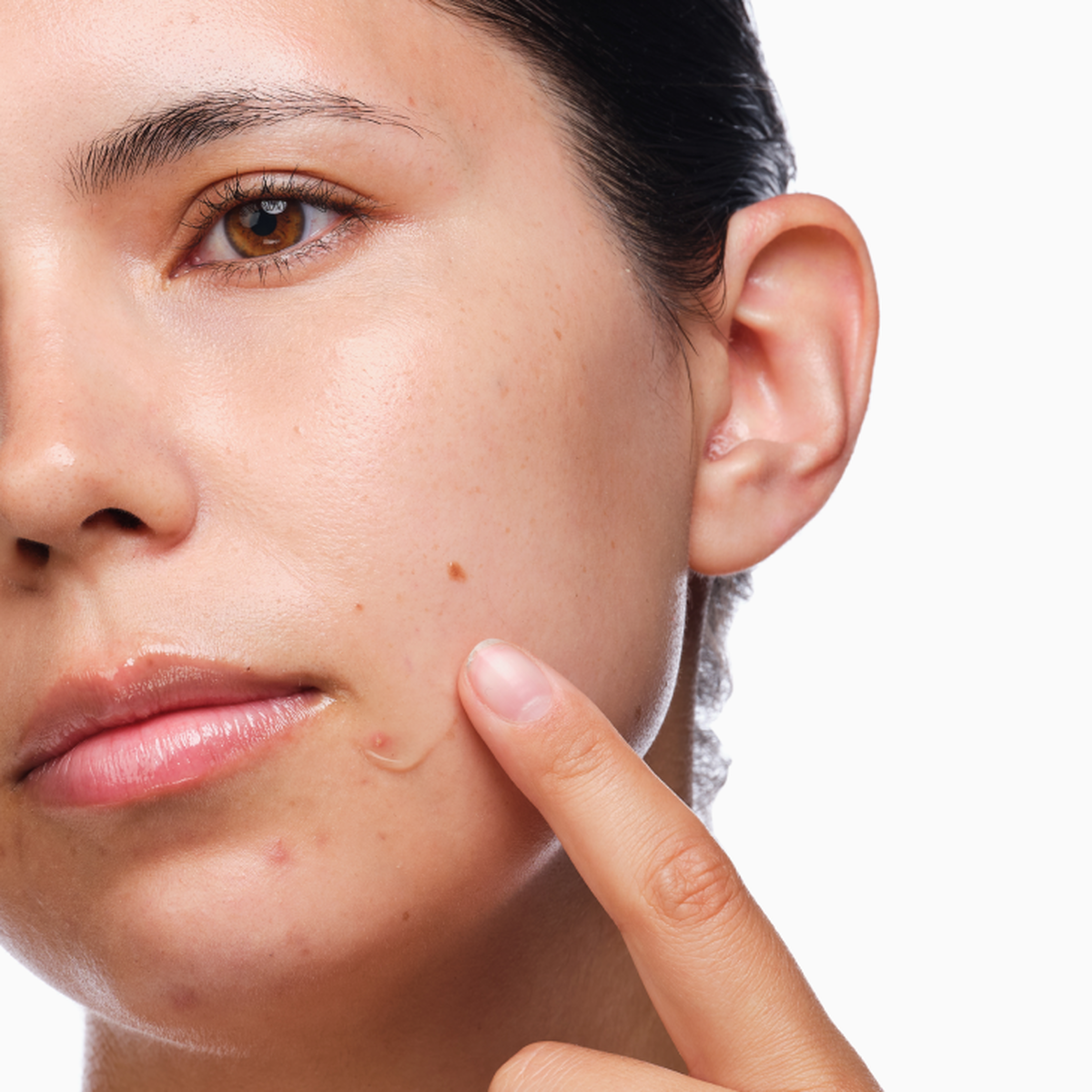 the-acne-set-x3 rdn-the-acne-set-application.png