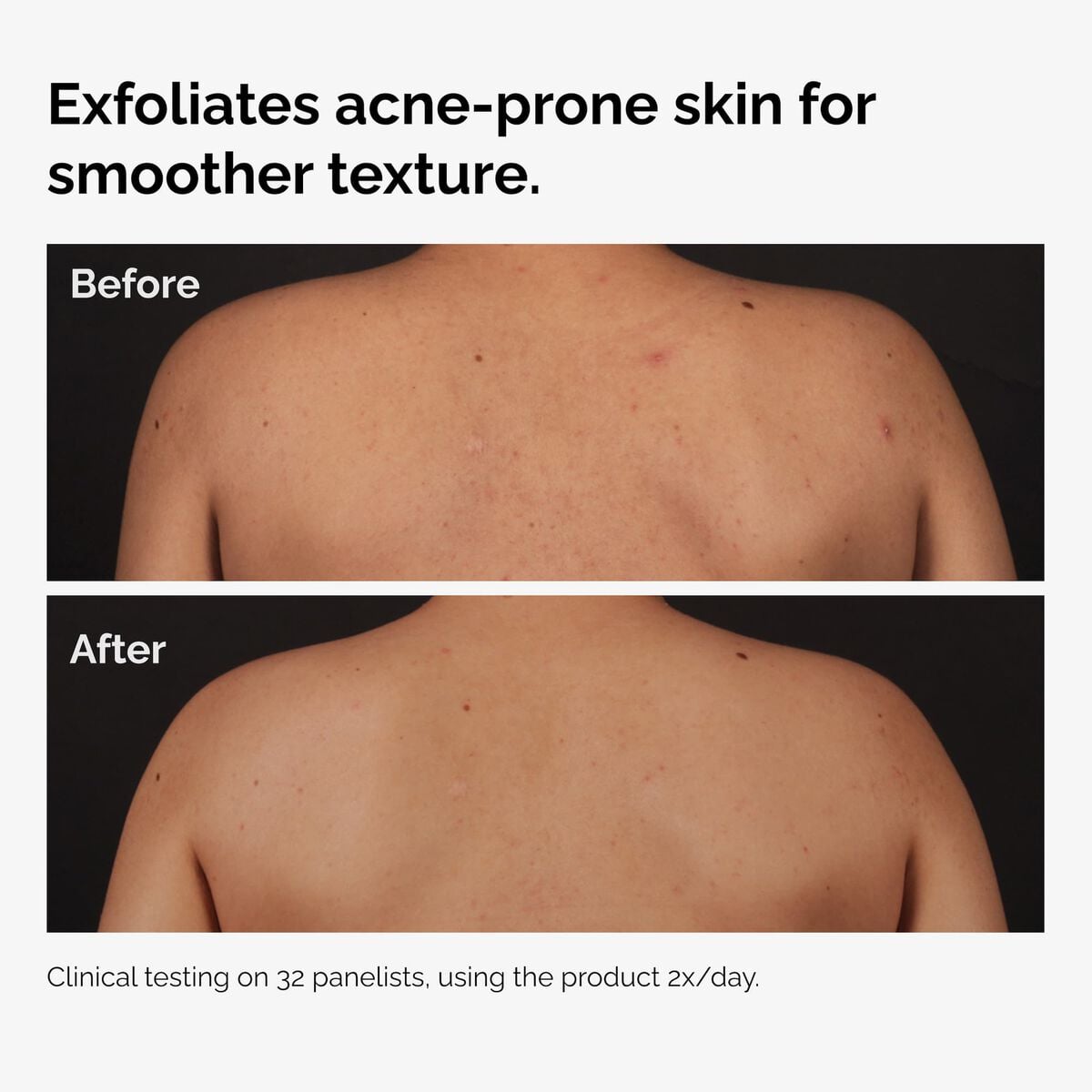 salicylic-acid-0-5-body-serum-j8 ord-salicylic-acid-body-serum-before-after-graphic-NA.jpg